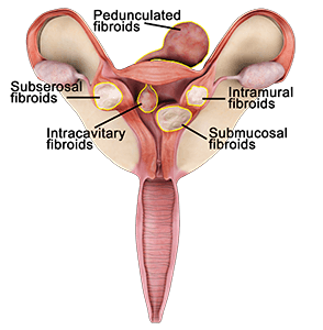 Fibroid Types